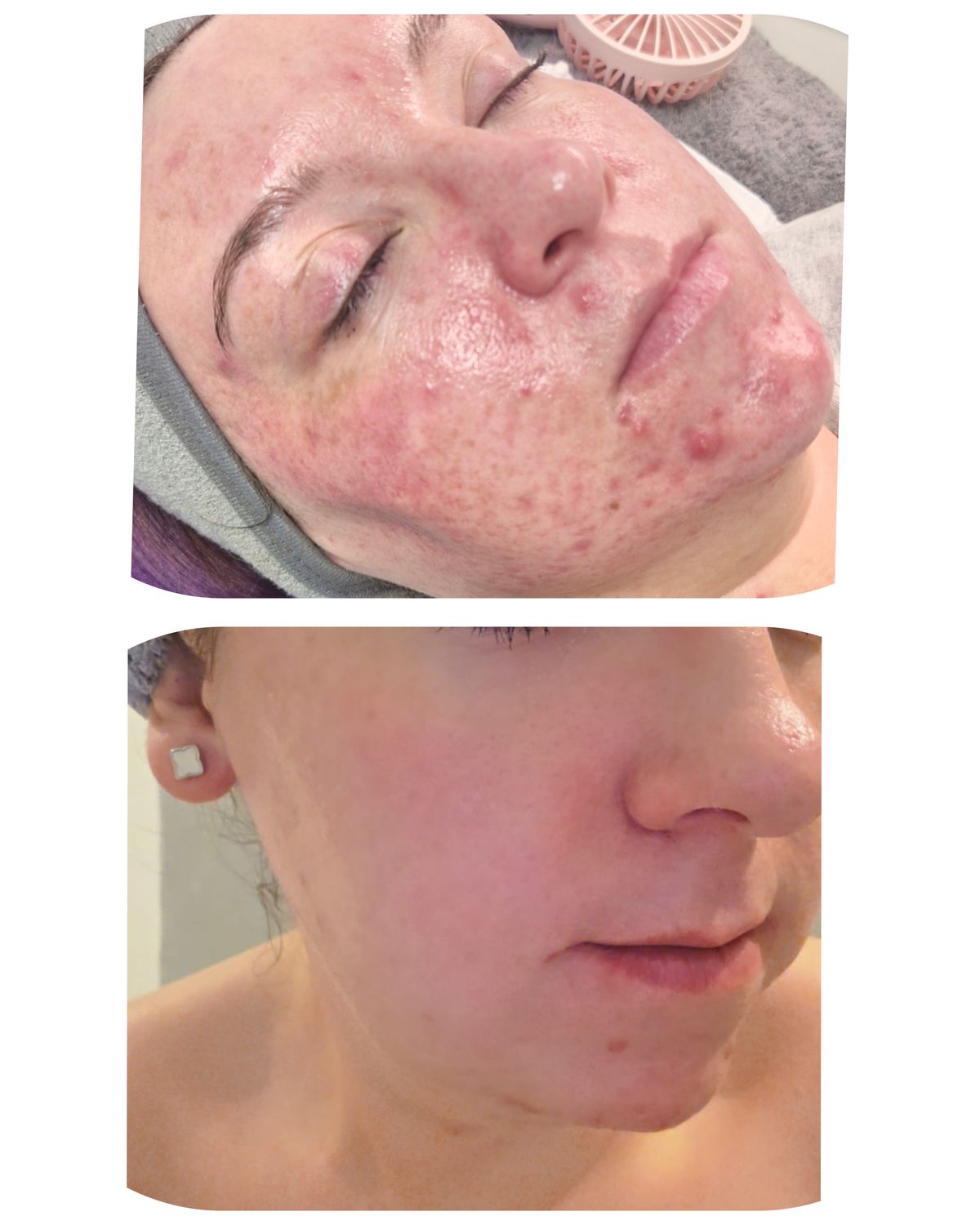 Beyond Breakouts: Professional Acne Treatment Results
