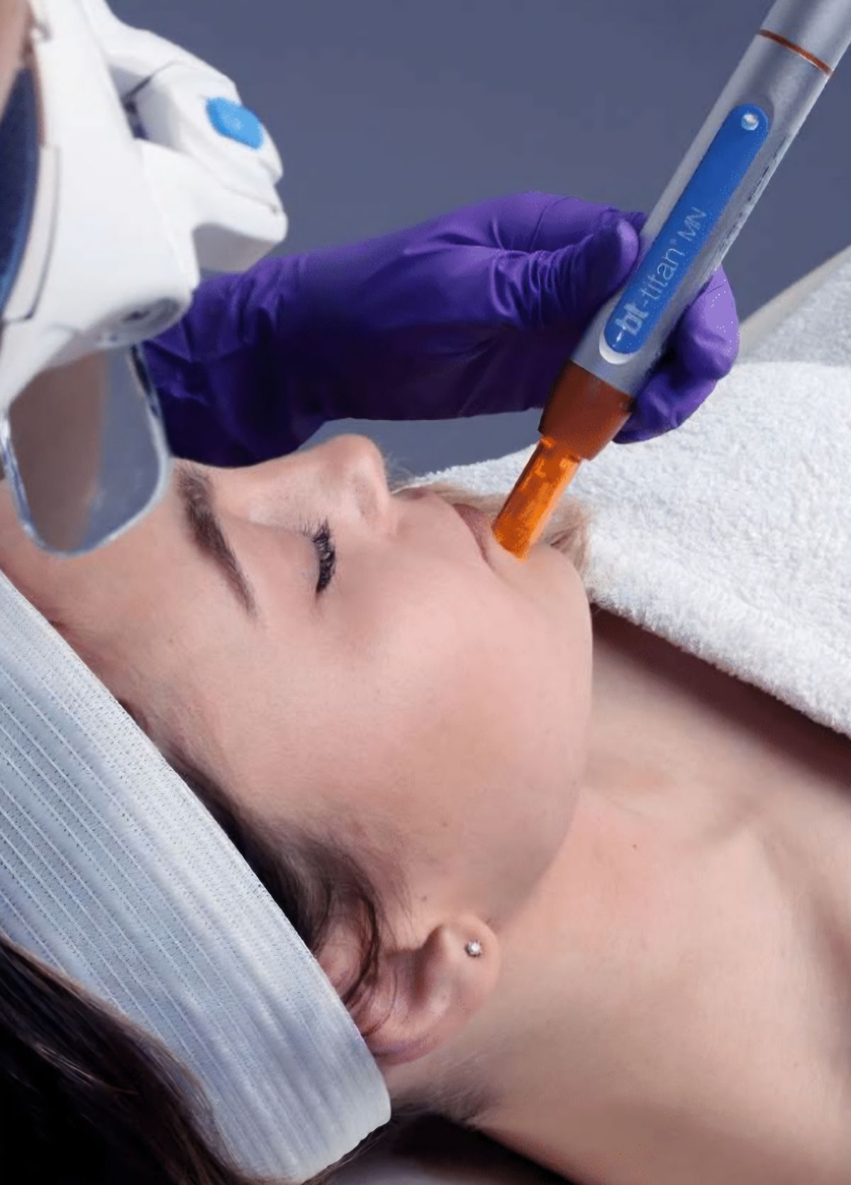 Microneedling: The Collagen Induction Treatment
