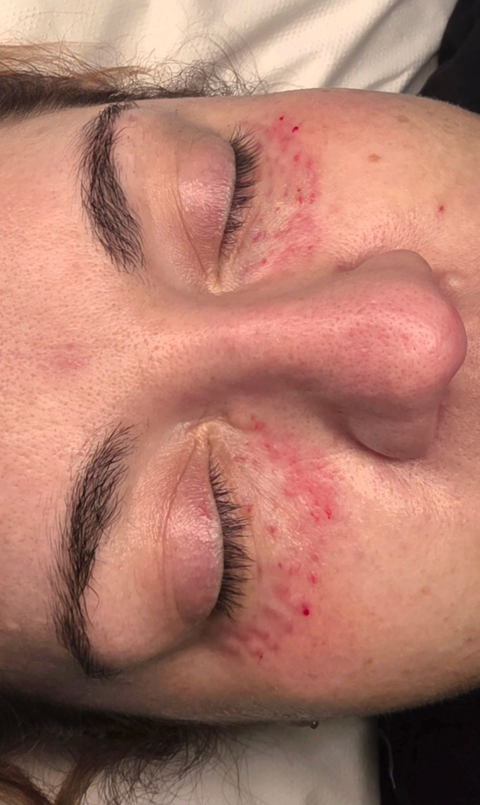 Polynucleotides: Regenerative Skin Repair