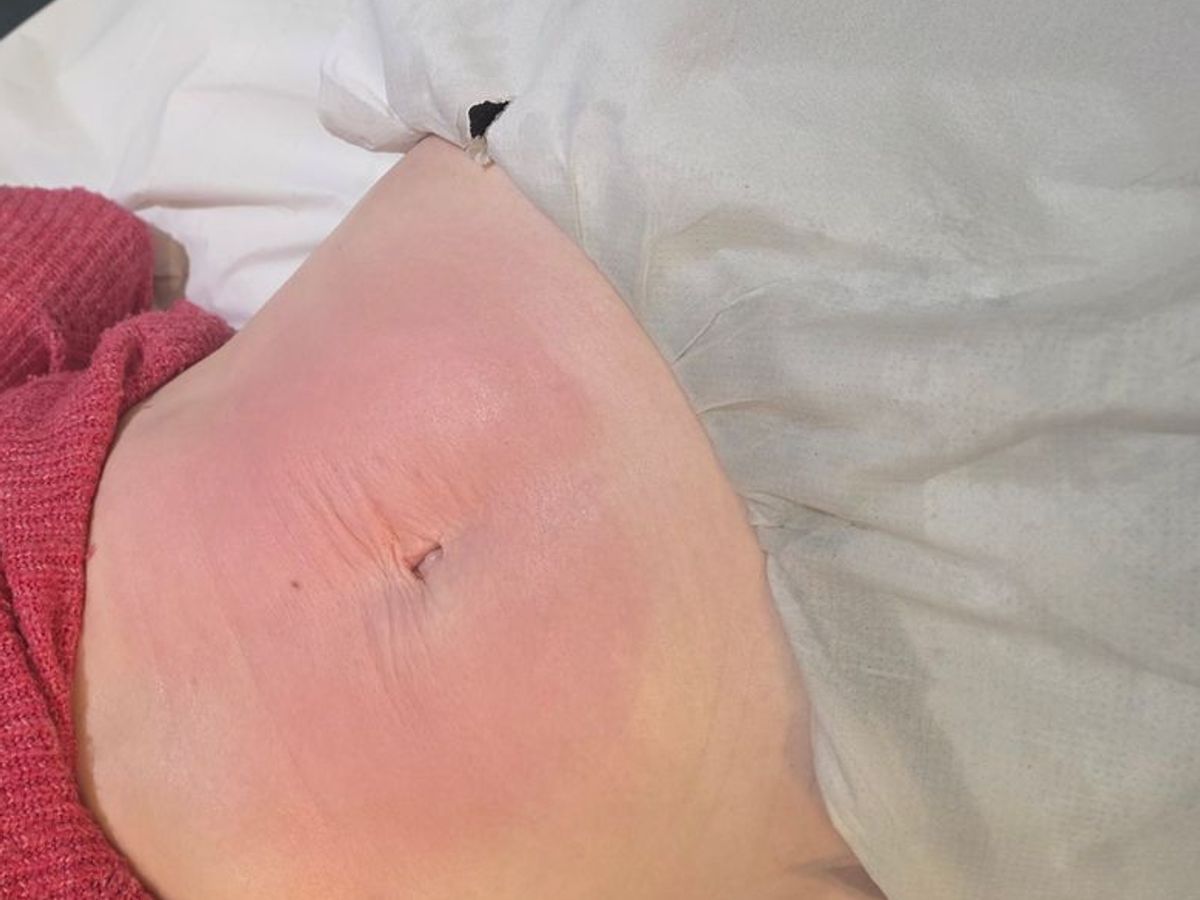 Radiofrequency Skin Tightening Without Surgery