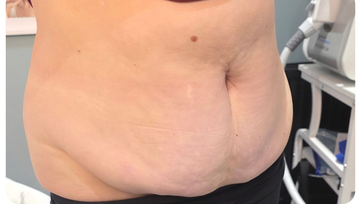 Ultrasound Cavitation: Non-Surgical Fat Reduction