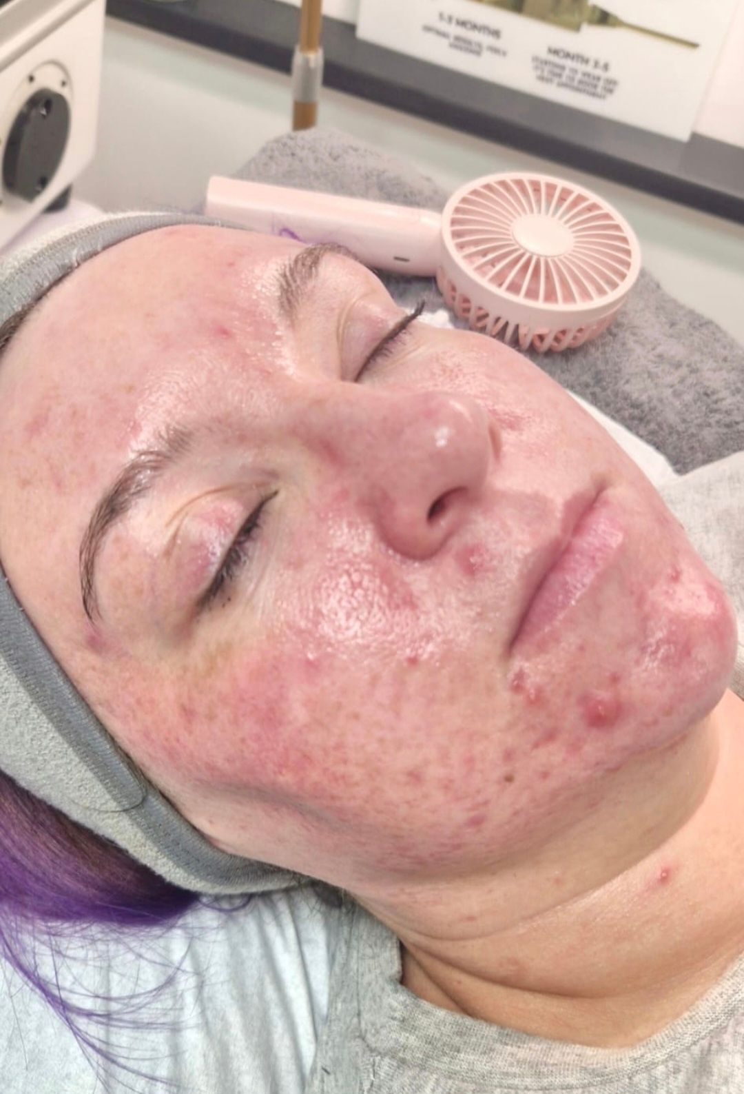 Cosmetic treatment result