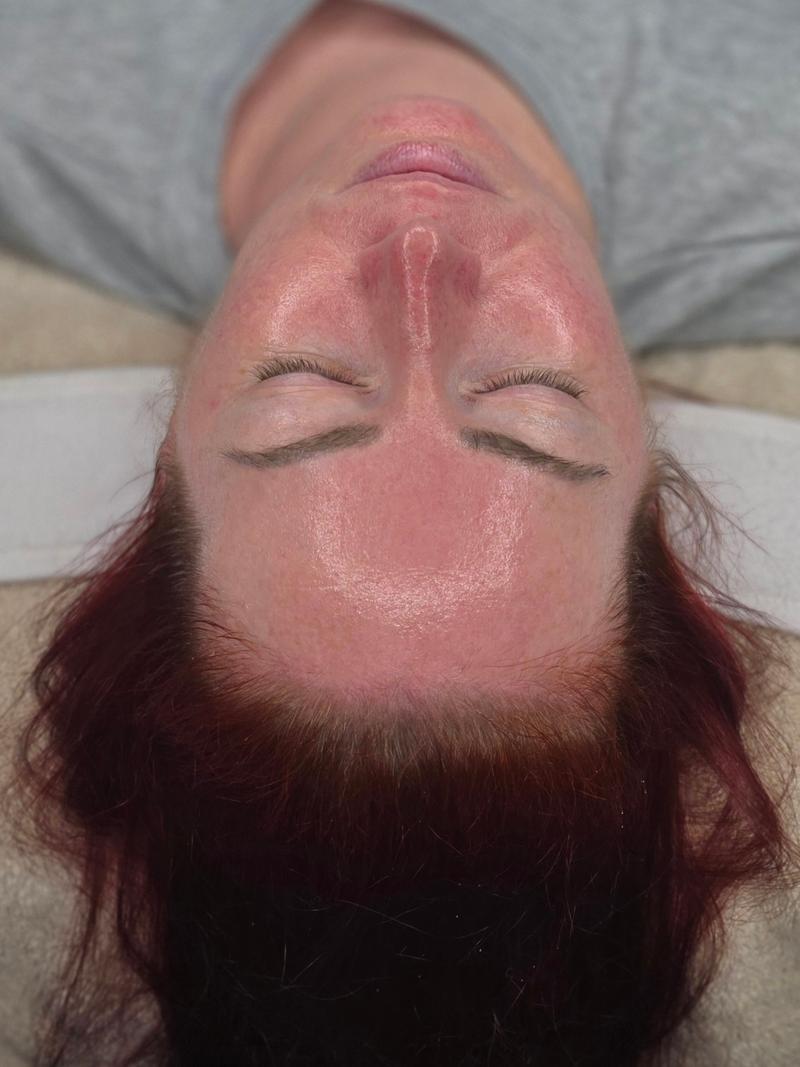 Facial treatment result