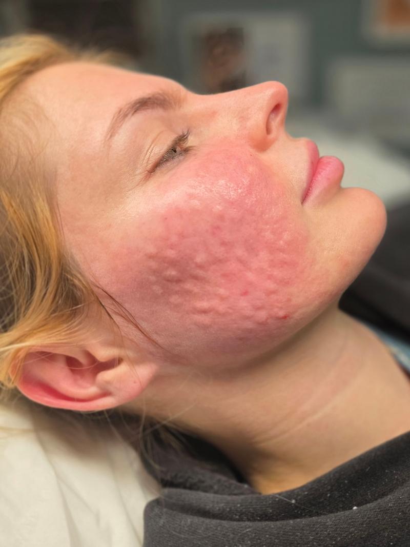 Rejuvenation treatment result