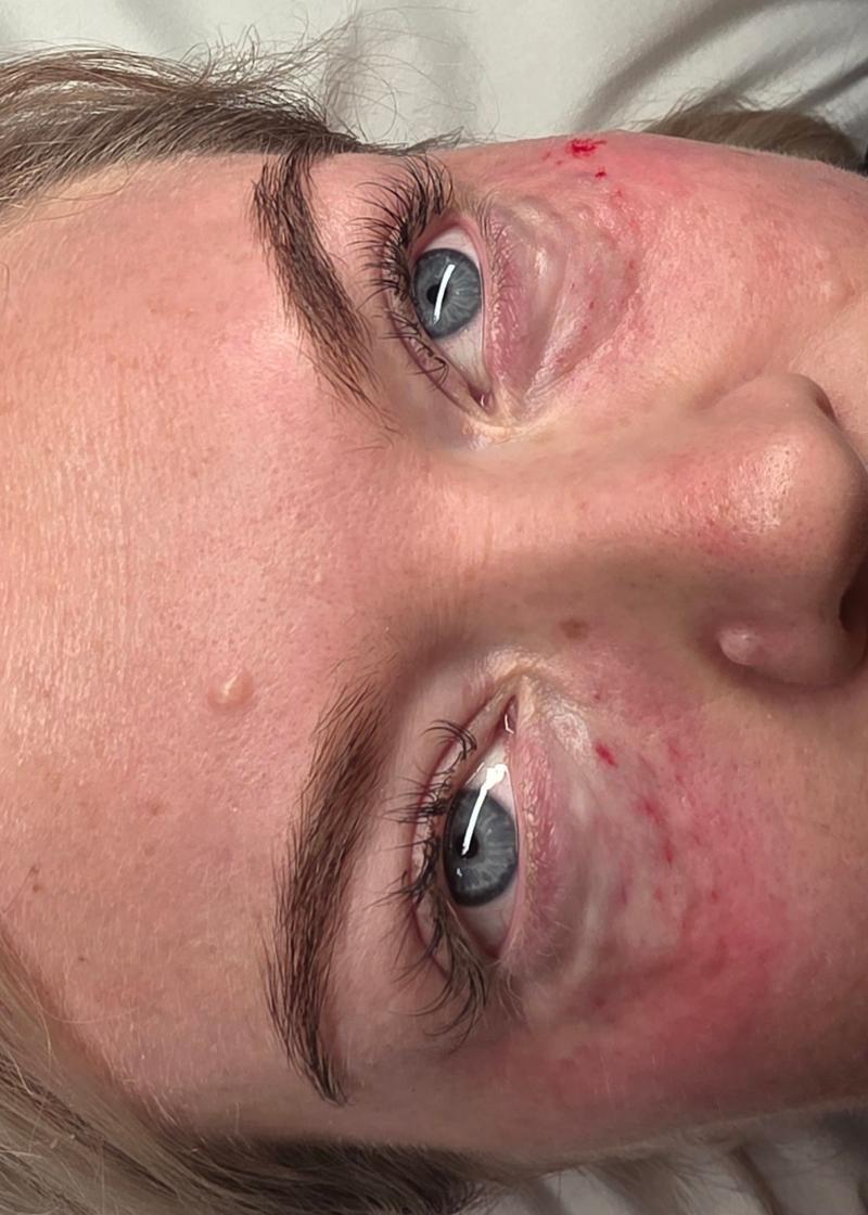 Body contouring treatment result