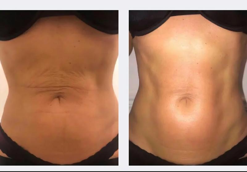 Laser treatment result