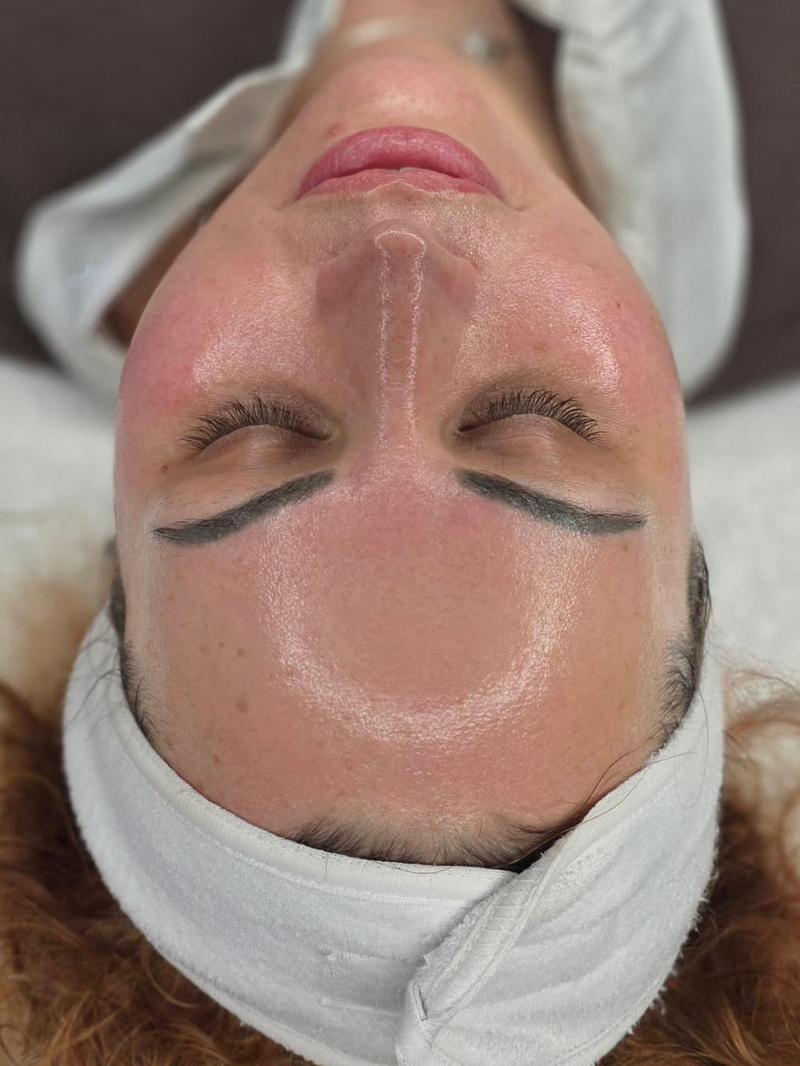 Anti-wrinkle treatment result