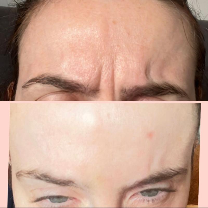 Dermal filler treatment result
