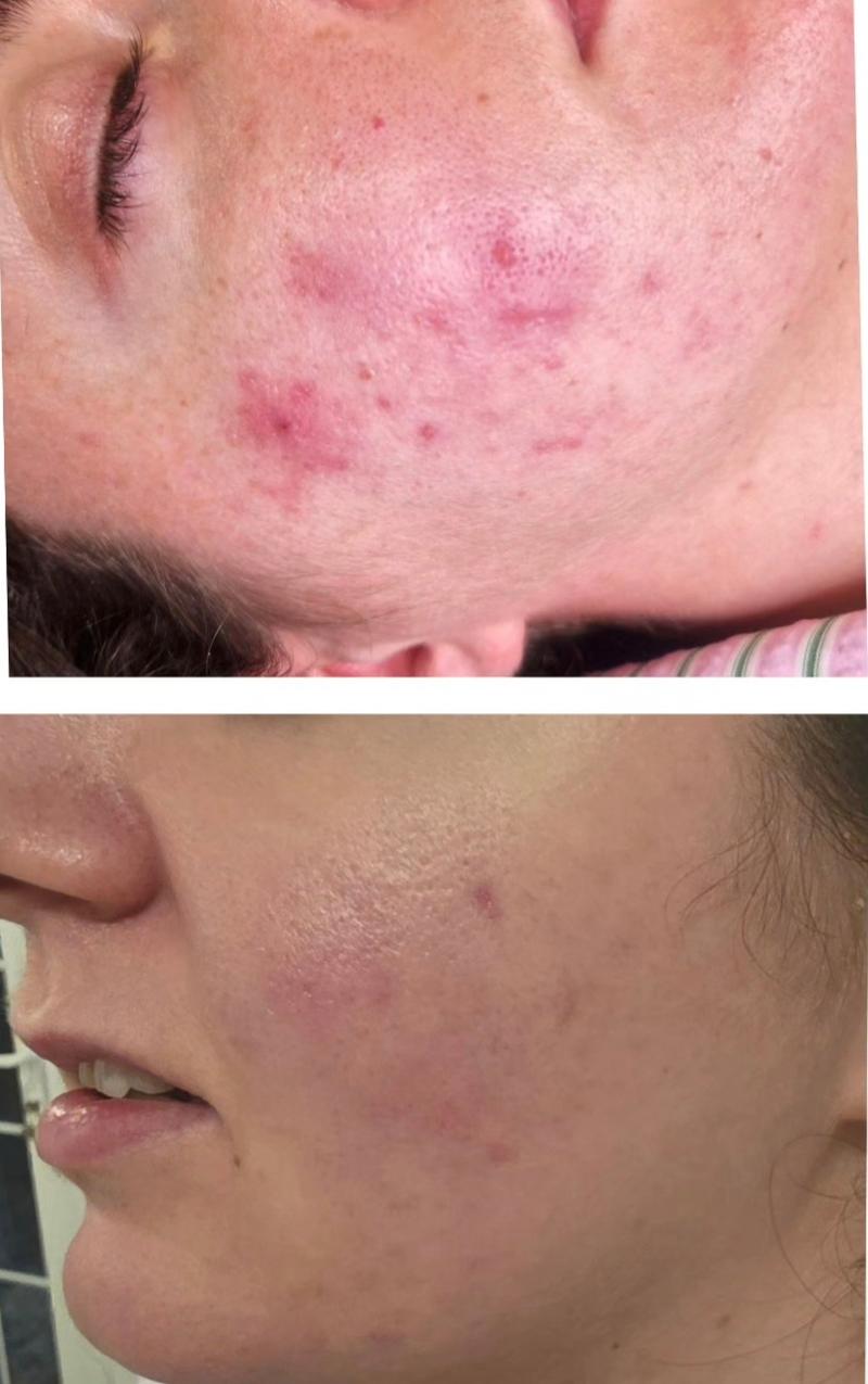 Microneedling treatment result