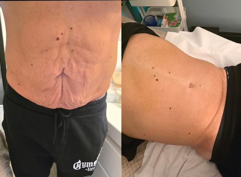 Chemical peel treatment result