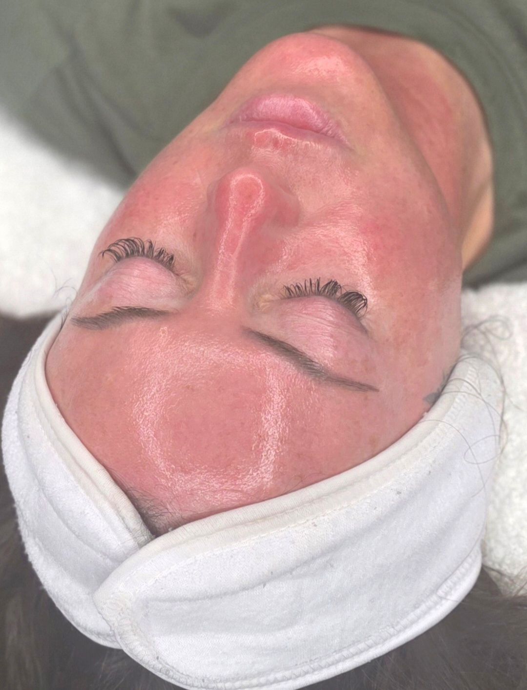 Skin rejuvenation result
